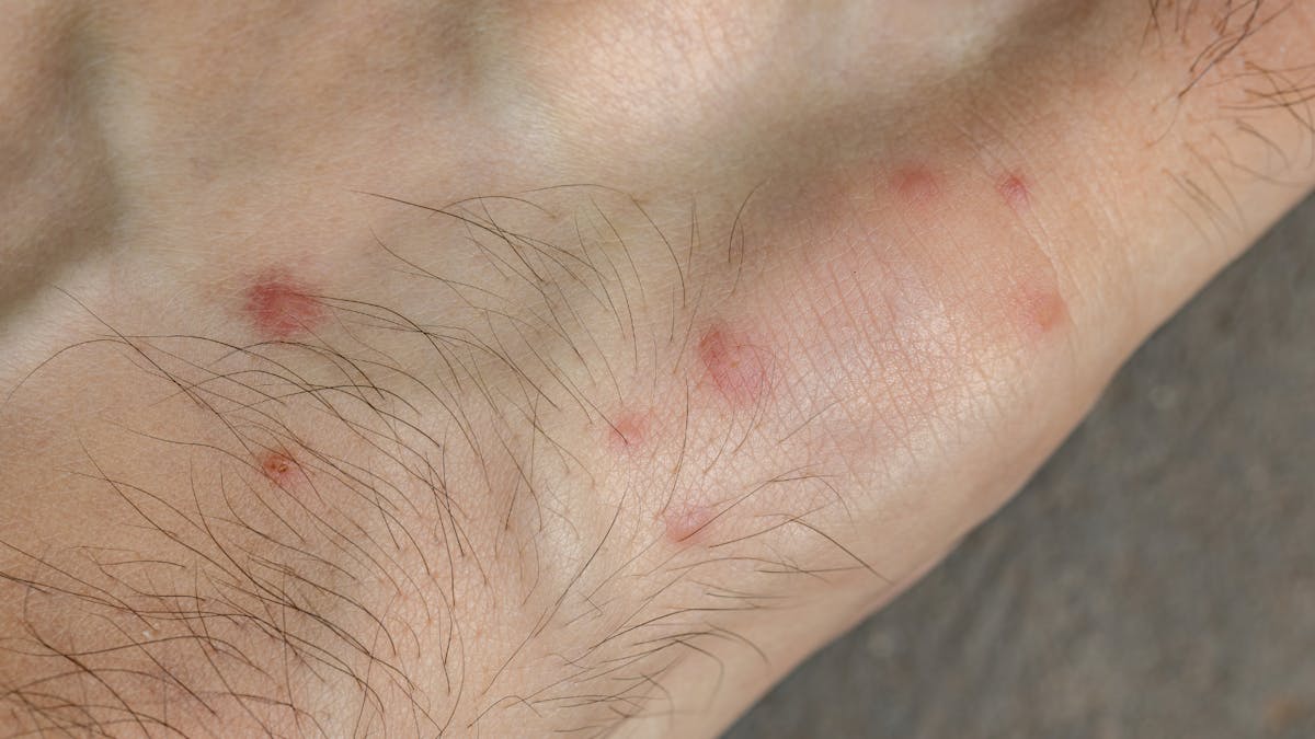 Bed Bugs Health Risks & How To Treat Bites medino