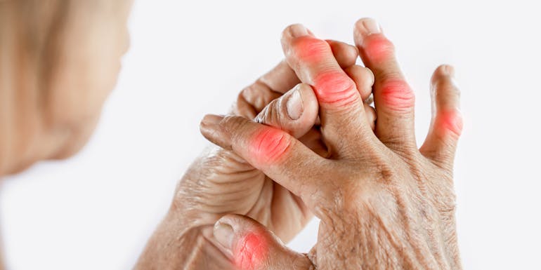 Inflamed Joints Image