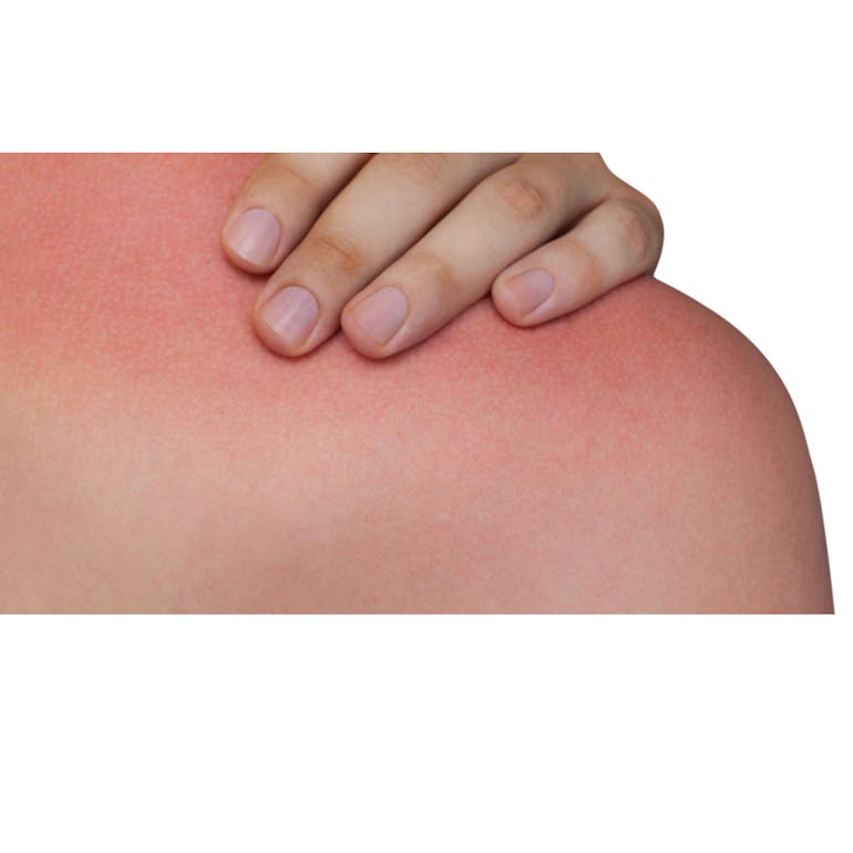 sunburned-shoulder-hand