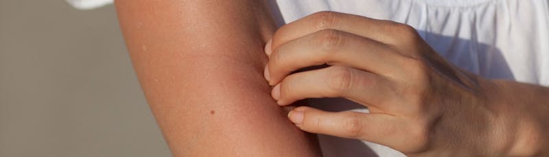 Atopic Eczema Explained: Symptoms & Treatments | medino